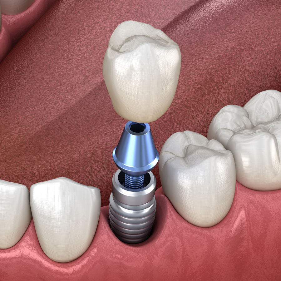 dental-implant-solutions