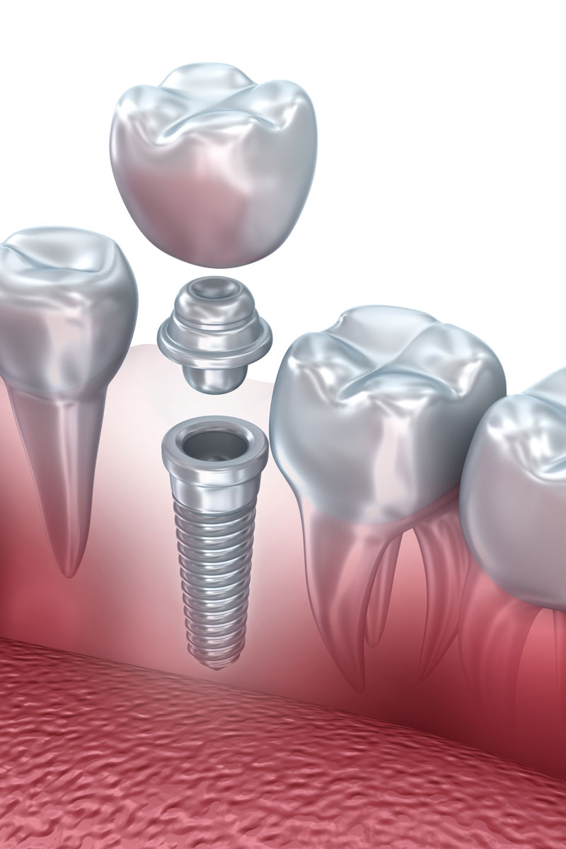 dental implants Geelong