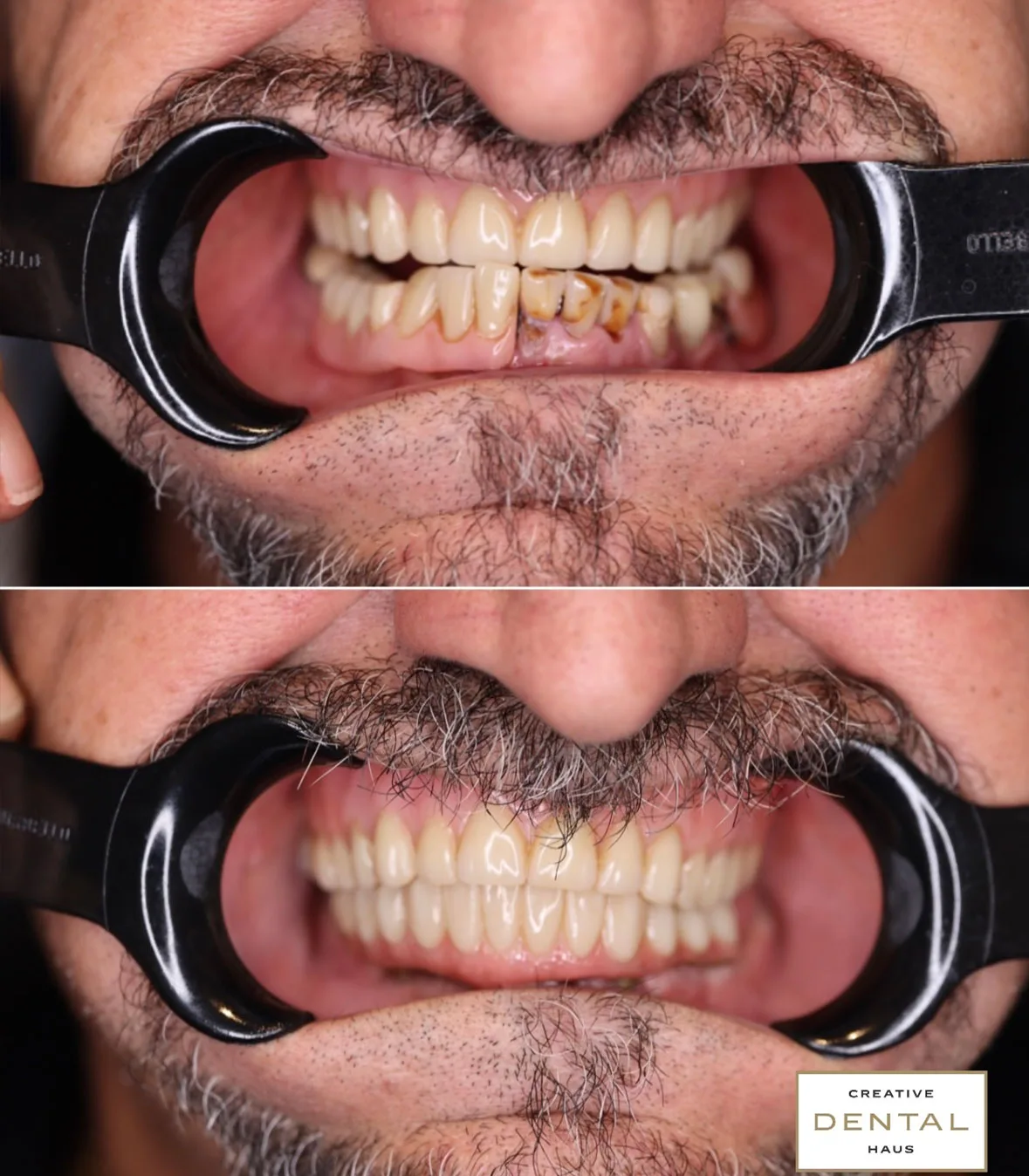 before after dental treatment case