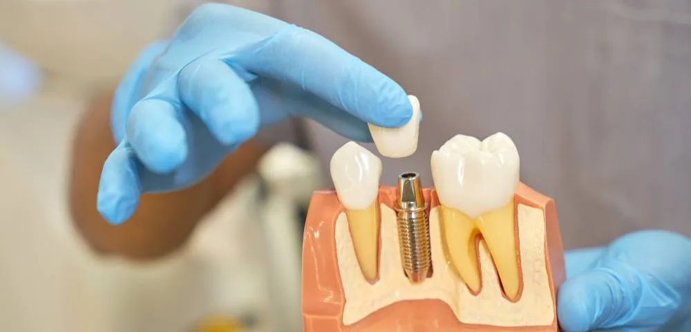 Dental Implants A Permanent Solution for Missing Teeth