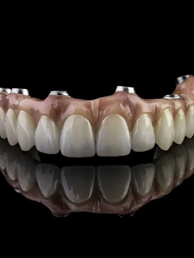 Advantages of All-on-4 Implants Over Traditional Dentures