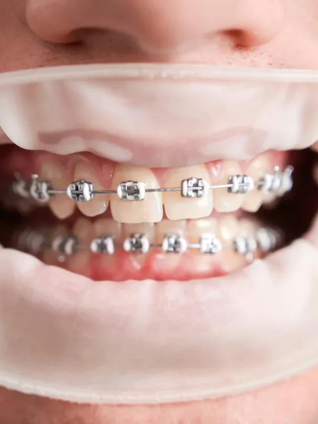 How to Choose the Right Braces for You?
