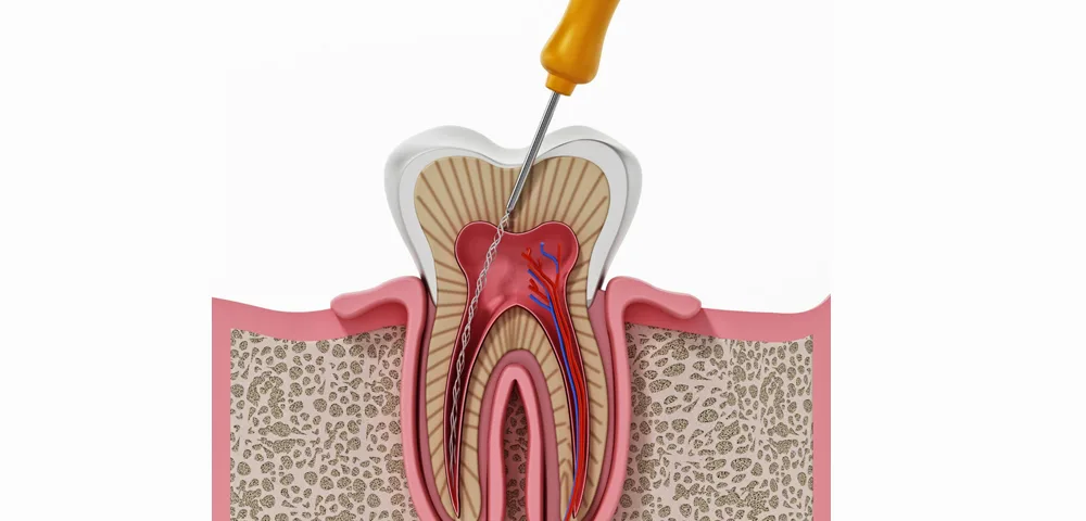 How Do I Know If I Need a Root Canal 1
