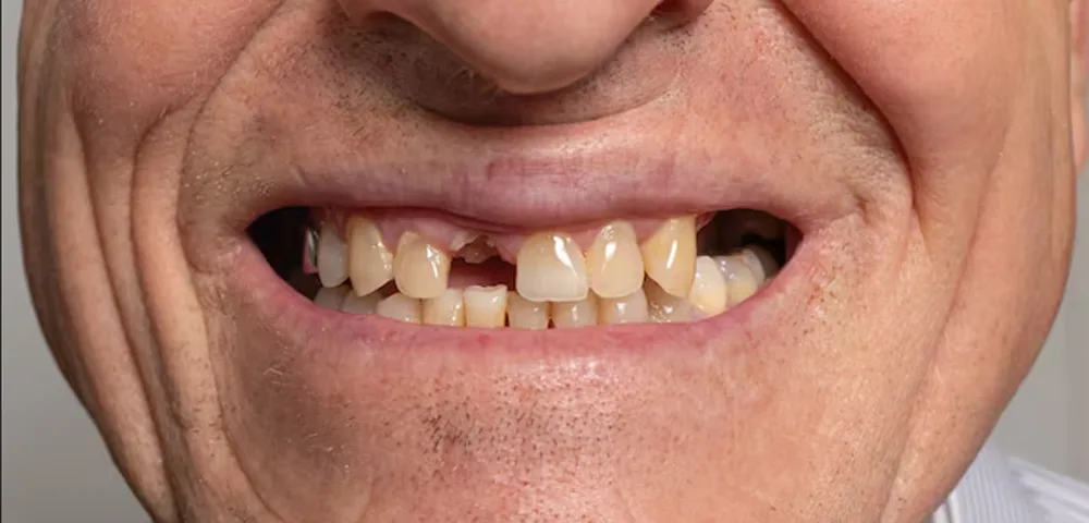 What are My Options for Missing Teeth